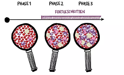 Schematische Abbildung der Phasen der CML Erkrankungen